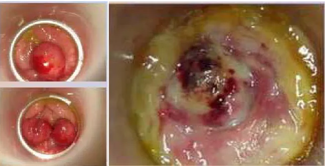 Figure 2. Immediate appearance post-ligature/appearance after fall of eschar. 