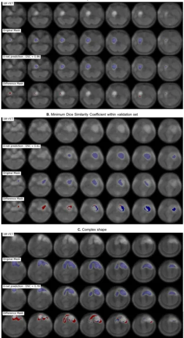 Fig 3. Segmentation examples with for each example: Original resized slices 18 F-FET (top), original mask (middle up), predicted mask + threshold (middle down) and difference between the predicted and original mask (bottom, with false negative in red and f