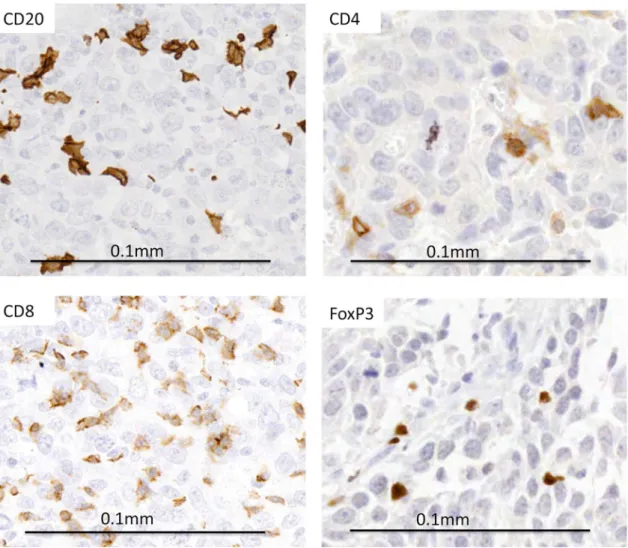 Fig. 1    Representative images of immunohistochemical staining (brown) of markers CD20 (for B lymphocytes), CD4 (helper T lymphocytes),  CD8 (cytotoxic T lymphocytes) and FoxP3+ (regulatory T lymphocytes) showing positivity within tumour nests