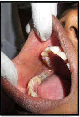 Fig. 2. Right buccal mucosabuccal mucosa 