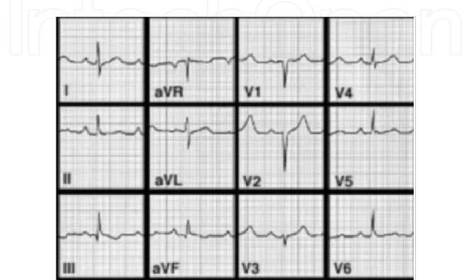 Fig. 2. 90% of individuals with ARVD have some EKG abnormality. The most common EKG  abnormality seen in ARVD is T wave inversion in leads V 1  to V 3 