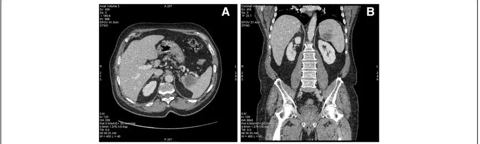 Figure 2 18F-FDG PET images of splenic metastasis. Axial section (A) and coronal section (B)