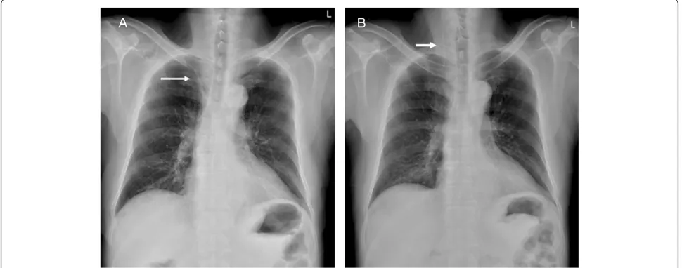 Figure 1 A 48-year-old man who underwent (A) venous port implantation experienced (B) catheter migration after 21 days.