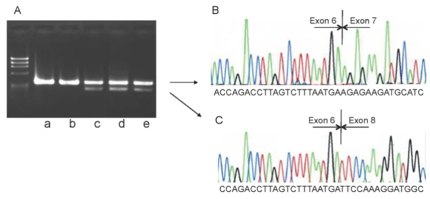 Figure 2Electrophoresis of cDNA and a fragment of the sequence cDNA from the patientElectrophoresis of cDNA and a fragment of the sequence cDNA from the patient