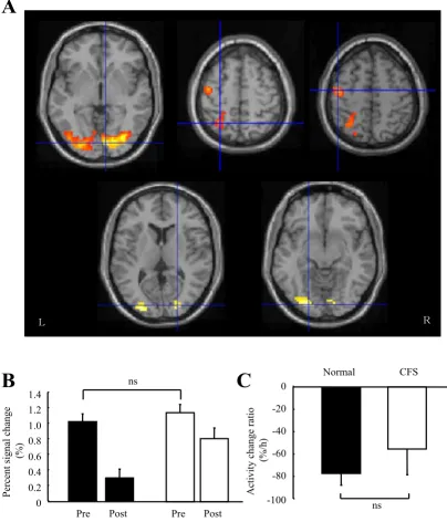 Figure 4Activity related to visual searchActivity related to visual search. (A) Statistical parametric maps activated by visual search (random-effect analysis of 13 sub-jects, P < 0.05, corrected)