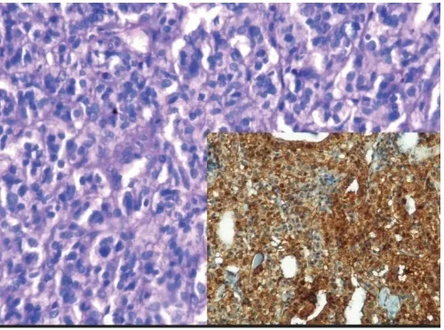 Figure 4. (H&E 20X)- Photomicrograph showing lymphocytic thyroiditis, Inset - (IHC 20X)- showing  gal-3 expression  in extracellular matrix in lymphocytic thyroiditis   