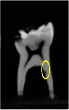 Figure 1.a furcation area  