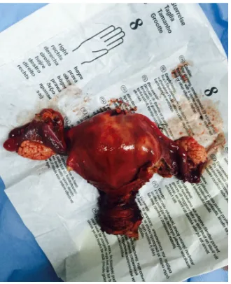 Figure 6. Total abdominal hysterectomy with bilateral oophorectomy and salpingectomy. 