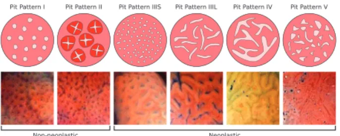Fig. 2. The 6 pit pattern types along with exemplar images and their assigned  classes in case of a two class (non-neoplastic vs neoplastic) differentiation