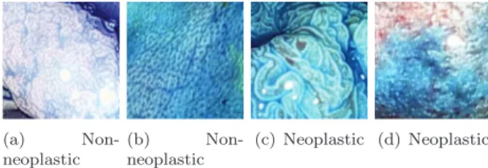 Fig. 4. Example images of the two classes obtained by a HD endoscope using a  combination of CC and i-Scan mode 2