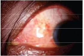 Figure 1 The patient’s eye diagnosed by “Differentiation of syndromes by observing eyes” Method in TCM