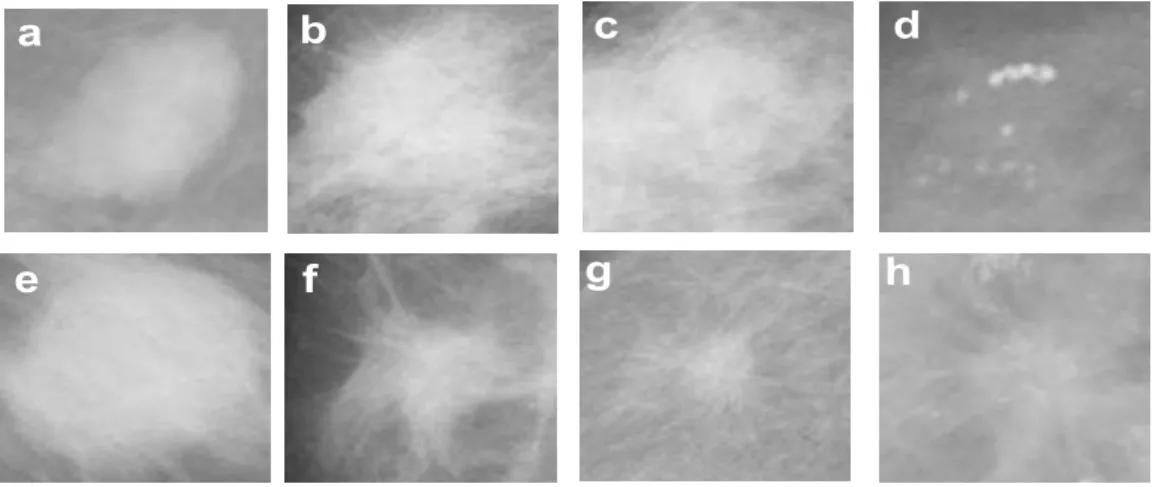 Figure 4.2: Extracted ROIs from different mammographic images (source: MIAS database)
