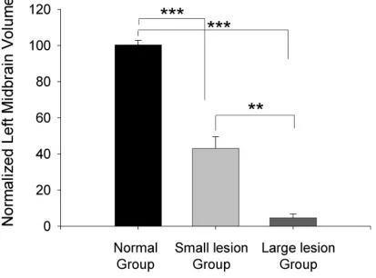 Figure 2.5.  Statistical comparison of midbrain size between normal and lesioned animals