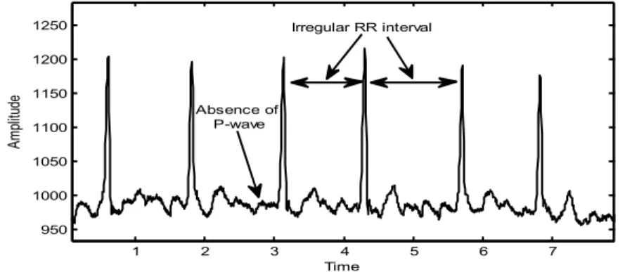 Fig. 1. RR interval and P peaks of atrial fibrillation rhythm. 
