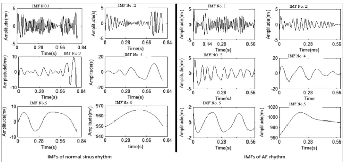 Fig. 2. IMFs of Normal and AF rhythm 