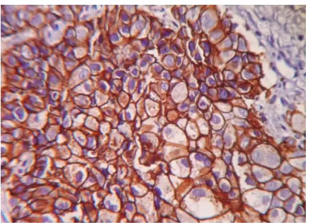 Figure 3. Membrane staining of HER-2/neu (3+) (original  