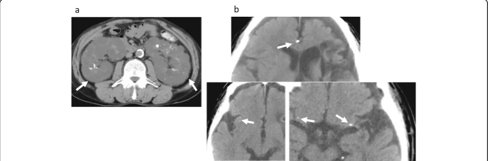Fig. 2 Radiologic findings in the proband.hamartoma ( a Unenhanced computed tomography scan shows multiple kidney cysts (arrow) and b skinarrow)