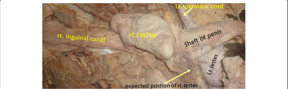 Fig. 1 A photograph that was taken of the cadaver showing the liver as seen from its visceral surface, presenting its different impressions, structuresand the additional lobe which is not usual in most liver specimens