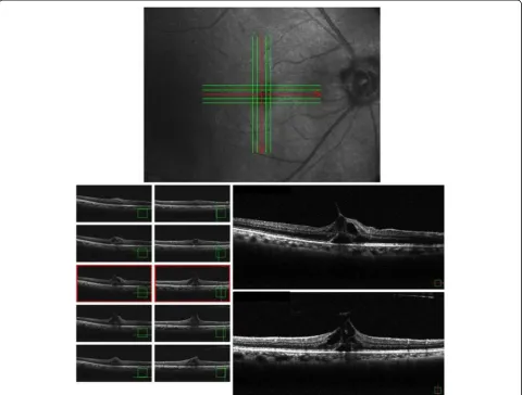 Fig. 1 Optical coherence tomography images obtained at the patient’s initial visit showing foveal retinal detachment and cystic formation, andthe retinal inner layer continuing in a bridge shape, thus confirming an impending macular hole (stage 1B macular hole)