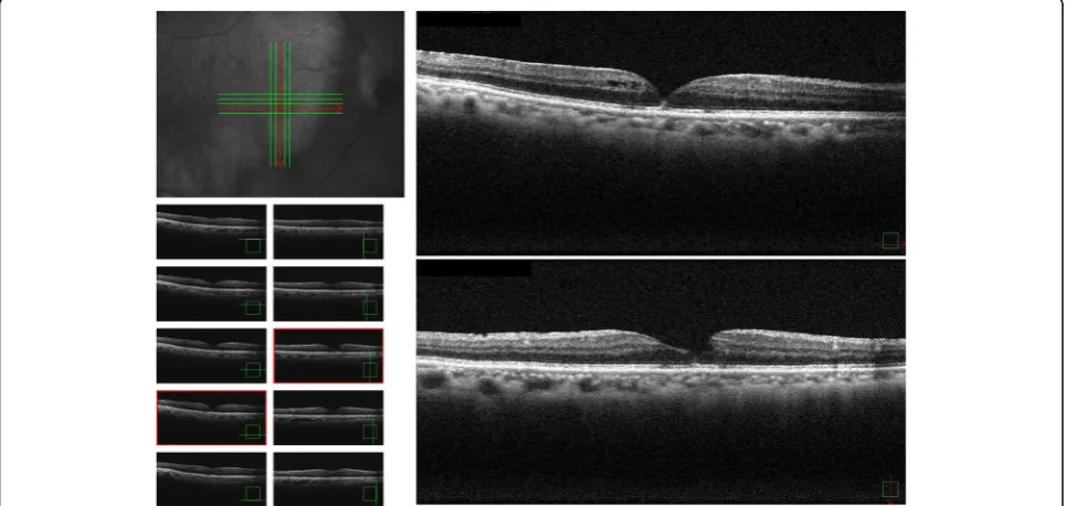 Fig. 4 Optical coherence tomography images obtained 6 months after spontaneous closure revealing a recurrence of the impendingmacular hole