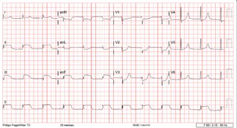 Fig. 1 Electrocardiography performed the morning after admission showed sinus rhythm with left-axis deviation and poor R-wave progression