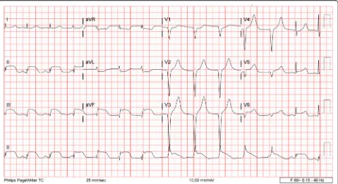Fig. 3 Electrocardiography performed after catheterization showed sinus rhythm with periods of accelerated idioventricular rhythm, inferolateralST elevations consistent with acute injury pattern, and prolonged QT interval
