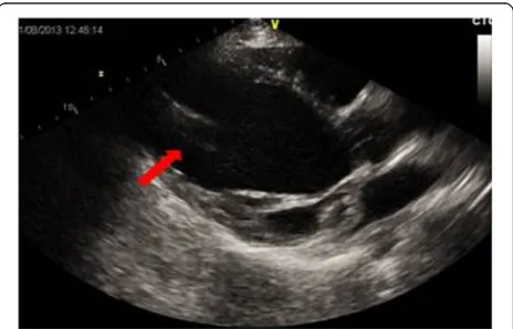Fig. 1 Pre-implantation echocardiographic images. Dilatation of the left ventricle and right ventricle, results of mitral valvuloplasty (arrow)