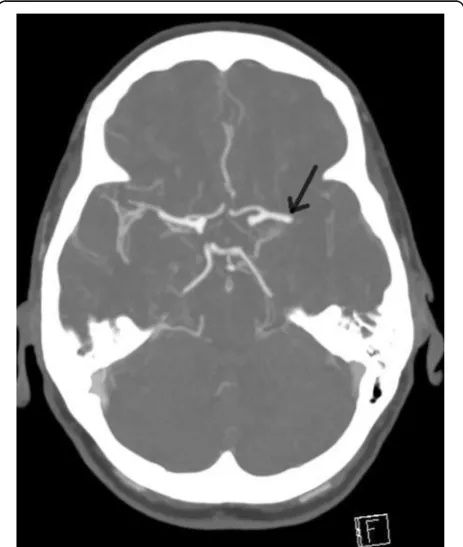 Fig. 1 CTA done during the stroke call, demonstrating filling defectin the left proximal MCA (arrowed)