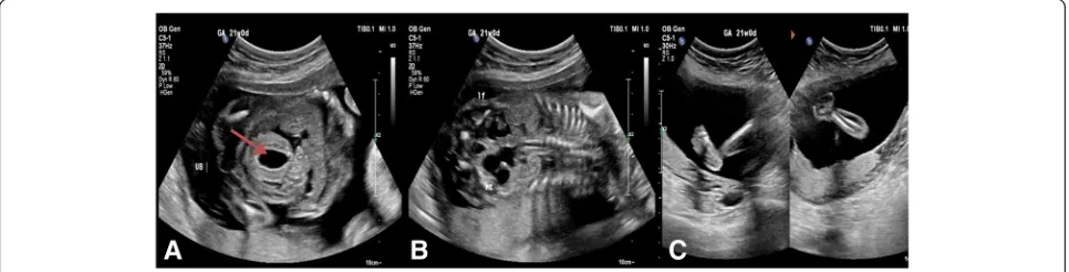 Fig. 1 Three images of the first anomaly scan at 21 weeks of gestation in which:distended urinary bladder wall; a an axial view of two-dimensional ultrasound shows fetal b a coronal view of two-dimensional ultrasound shows distended ureters; c an axial vie