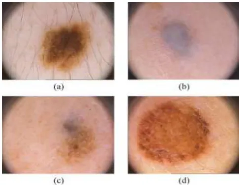Fig. 1. Difficulties of Dermoscopic Images; (A) Presence Of Hair; (B) Smooth Transition Between Lesion And Skin; (C) Multiple Colored Lesions; And (D) Specular Reflections