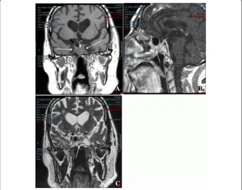 Fig. 3 Magnetic resonance imaging of the sella turcica 17 years after starting treatment with cabergoline.(heterogeneous contrast uptake demonstrating invasion of the sphenoid sinus (heterogeneous contrast uptake confirming the reductions of cavernous and 