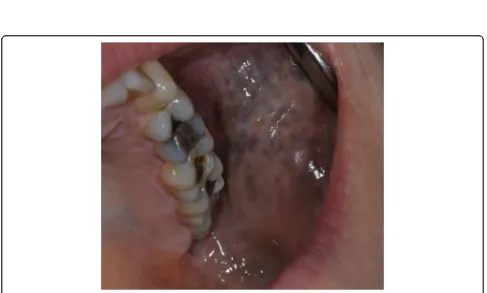 Fig. 1 Naevus of Ota affecting the left buccal mucosa