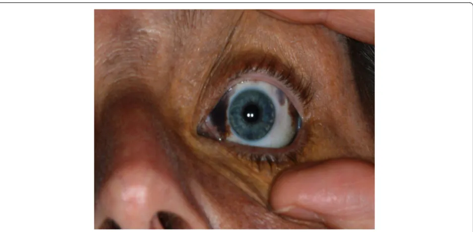 Fig. 5 Naevus of Ota afffecting the sclera of the left eye and post laser scarring