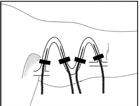 Figure 3.  Demonstration of needle insertionsneedle insertions 