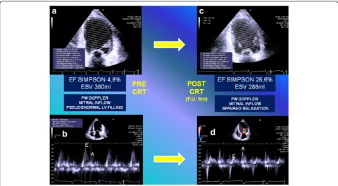 Fig. 5 Left sidePW: a Dilated left ventricle with an end-systolic volume of 380 ml, and an ejection fraction of 4.8% as was measured by the modifiedSimpson’s method pre-implant