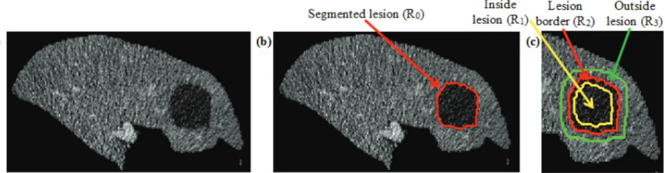 Fig. 2. Liver lesion ROIs: (a) segmented liver; (b) segmented lesion (R 0 ); (c) Three ROIs; inside lesion R 1 is yellow; boundary lesion R 2 is red;