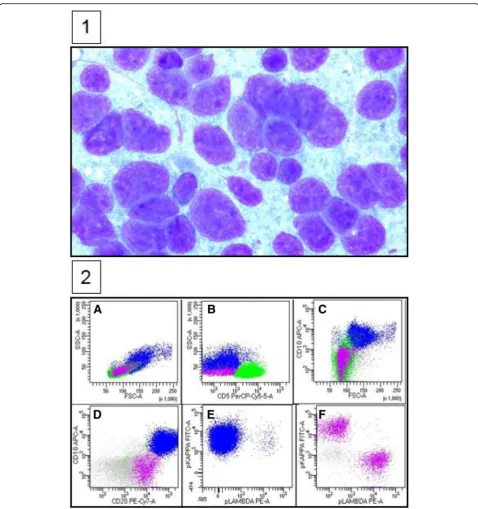 Fig. 2 Lymphoma biopsy. 1 Cells are composed predominantly of large lymphocytes two to three times larger than normal background smalllymphocytes (Diff-Quik stain, × 100)