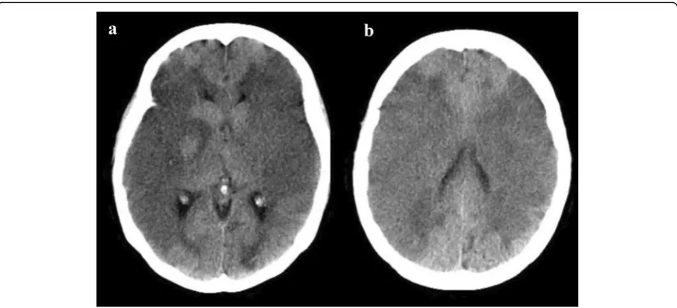 Fig. 3 Computed tomography of the brain. a Decrease in attenuation and loss of gray-white differentiation of bilateral cerebralhemispheres supplied by the middle cerebral artery territories, with a narrowing of the bilateral lateral ventricle due to compre
