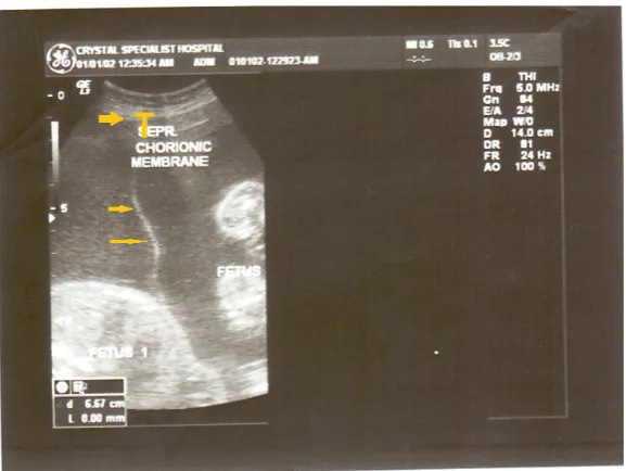 Figure 1. Frozen sonogram of monochorionic monoamniotic twins at 8 weeks gestational age