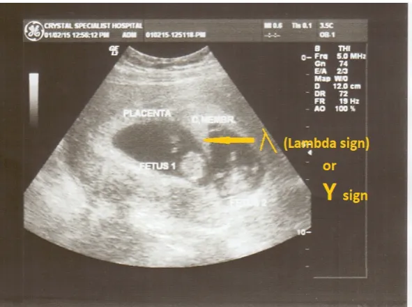 Figure 3. Showing ultrasound image of thick chorionic membrane (CM) in dichorionic diamniotic twins at 8weeks