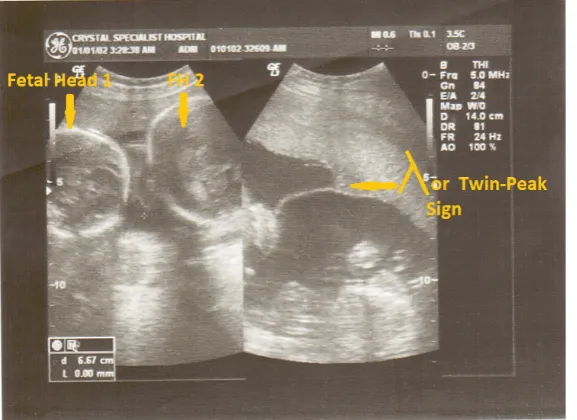 Figure 4. Transverse ultrasound image of chorionic membrane in dichorionic diamniotic twins at 25 weeks gestational age
