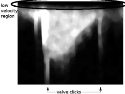 Figure 2: The outﬂow velocity proﬁle from a healthy volunteer. The low velocity region is marked with the black ellipse, and the valve clicks which deﬁne the relevant part of the phase cycle are marked with arrows at the bottom of the ﬁgure.