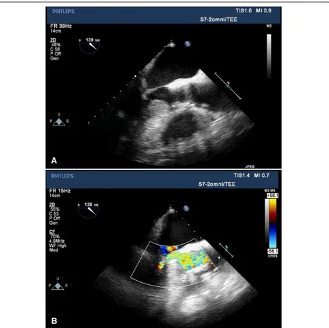Fig. 1 Intraoperative transesophageal echocardiogram, mid-esophageal long-axis view obtained after rapid pacing and valve deploymentdemonstrating (a) systolic anterior motion of the mitral valve leading to severe restriction of flow (b) as demonstrated on color Doppler imaging
