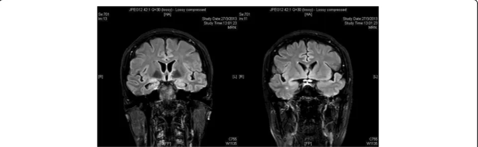Fig. 1 Magnetic resonance imaging of the brain with contrast performed on 27 March 2013