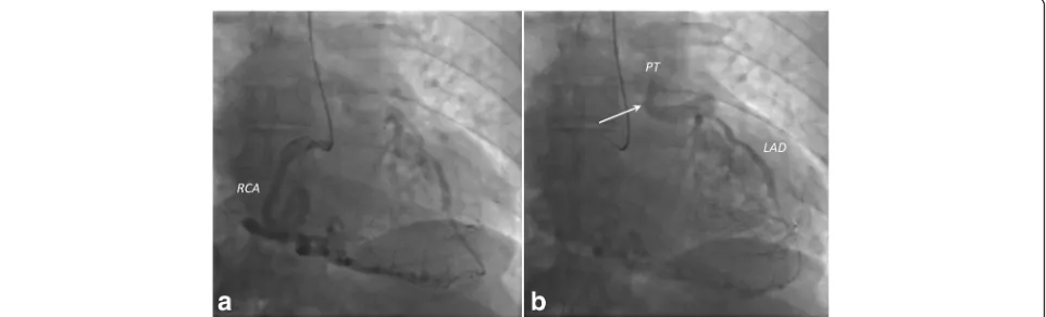 Fig. 5 a and b Axial (a) and coronal (b) maximum-intensity projection (10 mm) coronary computed tomographic angiographic images showingdilated bronchial arteries (Br) anastomosing to the left circumflex artery (LCx) (arrows)