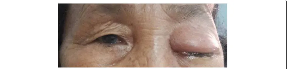 Fig. 1 A 65-year-old woman presenting with left-sided proptosis with lid edema