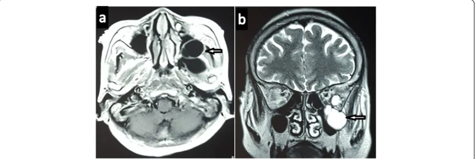 Fig. 2 Axial computed tomography images of head and orbit showing multiloculated cystic lesion involving the left infratemporal fossa (a)extending to the extraconal space of left orbit (b)