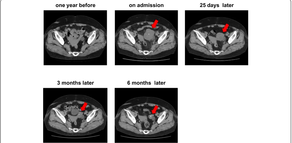 Fig. 1 Abdominal computed tomography (CT) one year before (panelcalcification in the pelvis which was observed in abdominal CT one year before