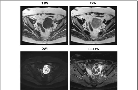 Fig. 2 Magnetic resonance imaging axial T1-weighted images through the pelvis showed a markedly dilated fallopian tube posterior to the leftovary