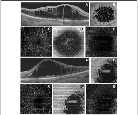 Fig. 3 Swept source optical coherence tomography and optical coherence tomography angiography in right eye (enhanced S-cone syndrome